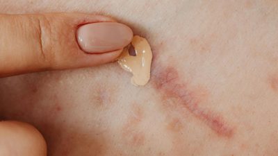 بهترین راهکارهای پزشکی و خانگی ثابت شده برای از بین بردن جای زخم جدید و کهنه